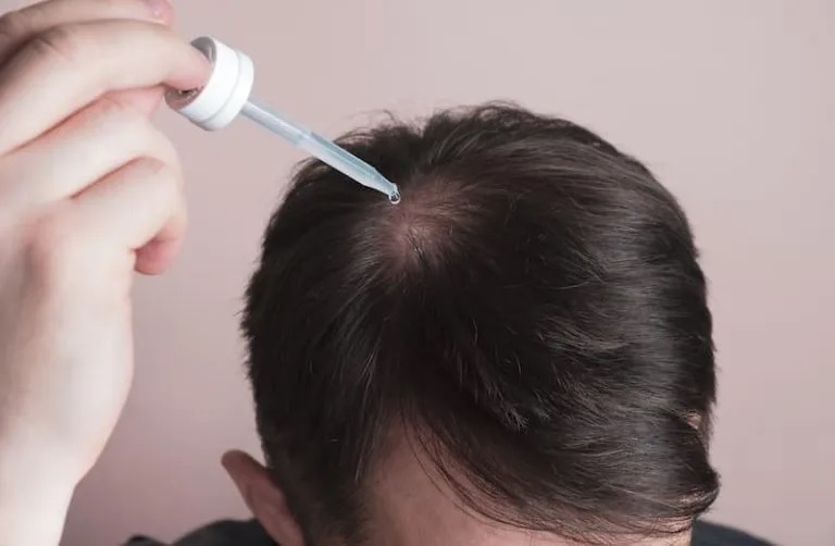 How Long After Stopping Minoxidil Does Hair Fall Out?